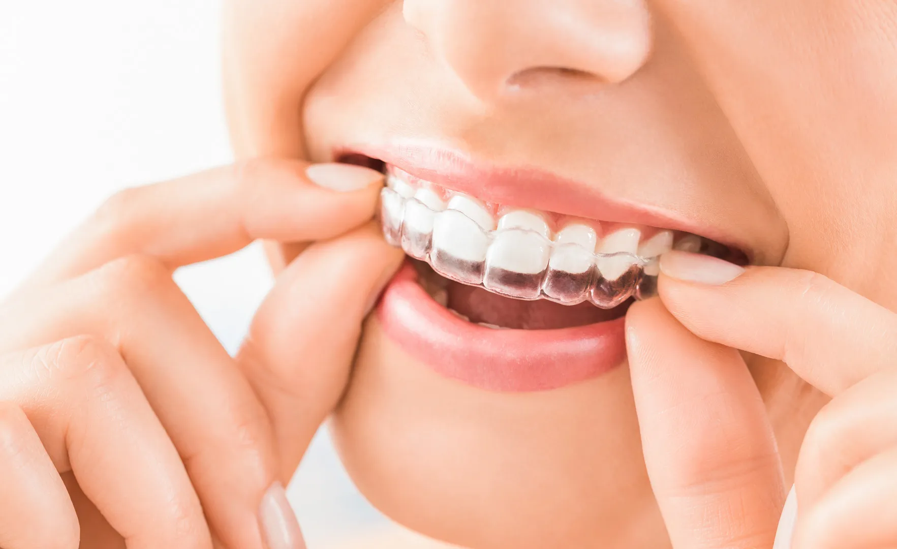 Invisalign in Kearny Mesa