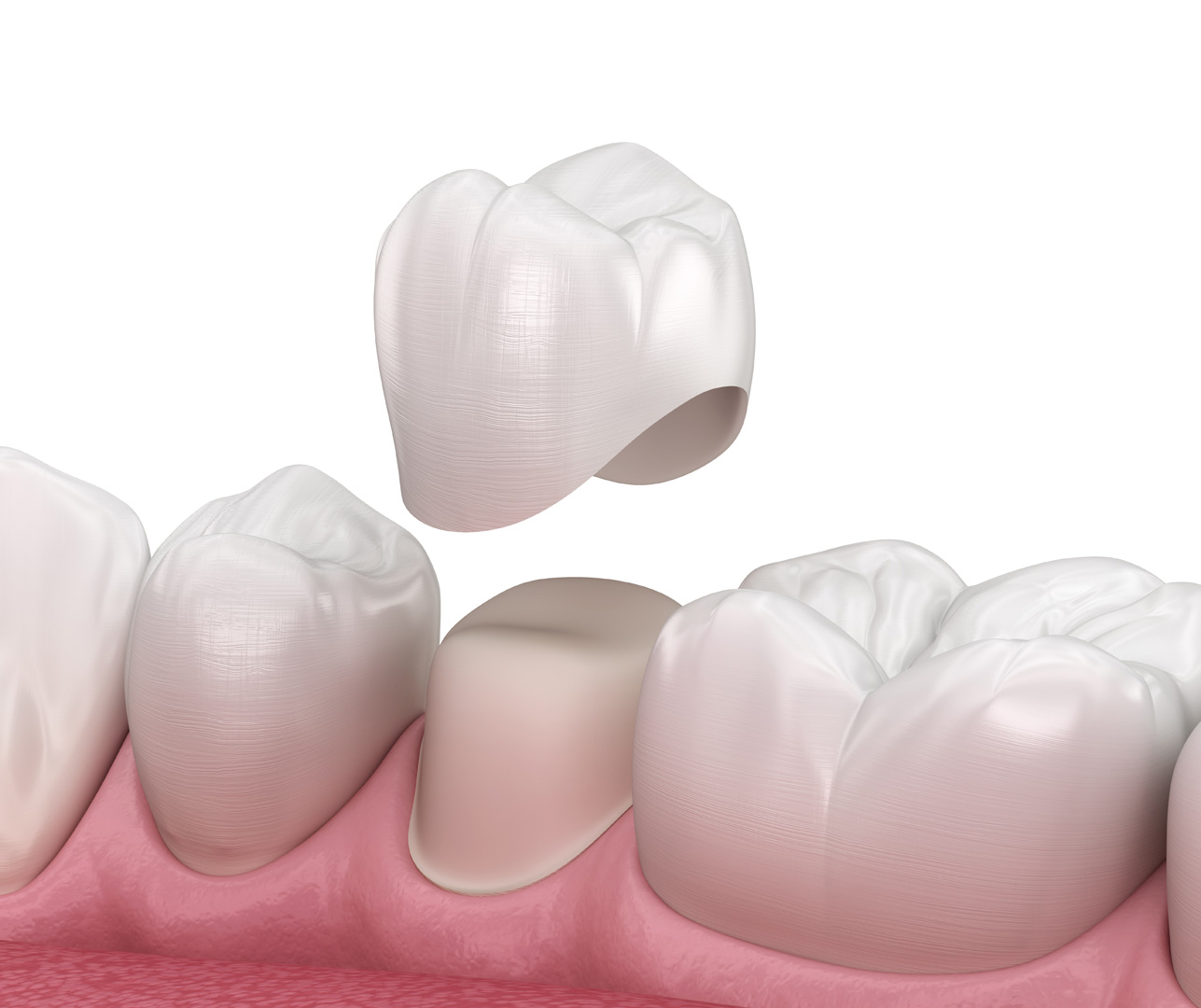 Dental Crowns: Types, Benefits, Definition & Necessity
