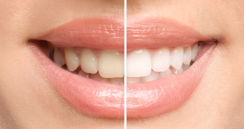 6 Ways In Which Teeth Whitening Can Be Of Effective Help