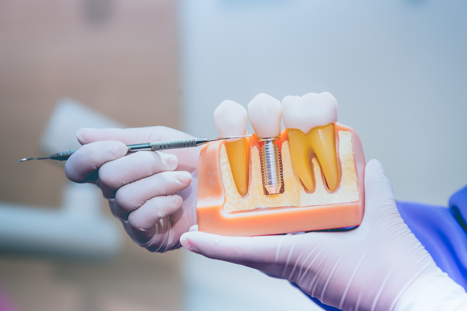 Everything You Need To Know About Dental Implants