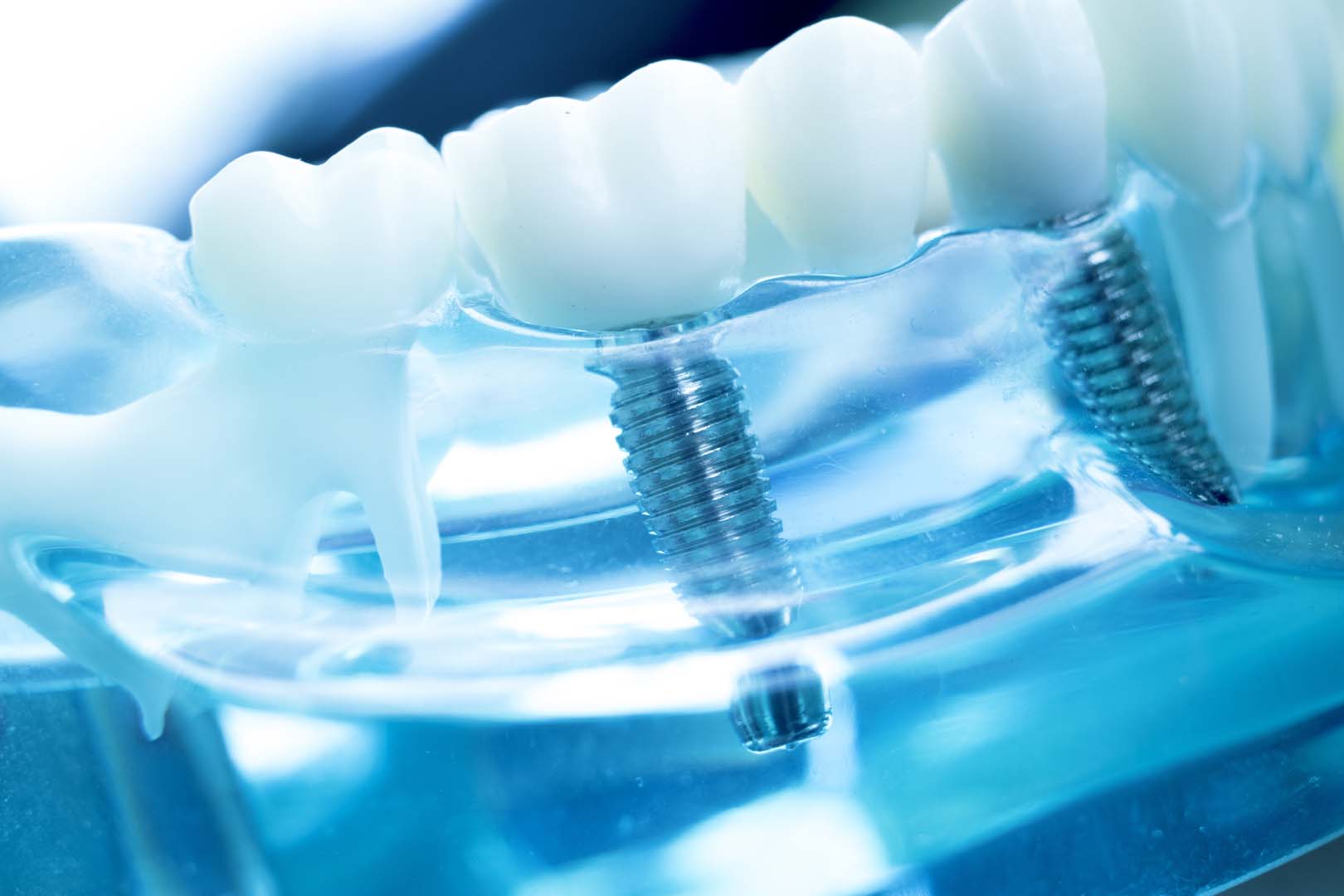 Signs You Might Need a Dental Implant: Insights from Aero Dentistry