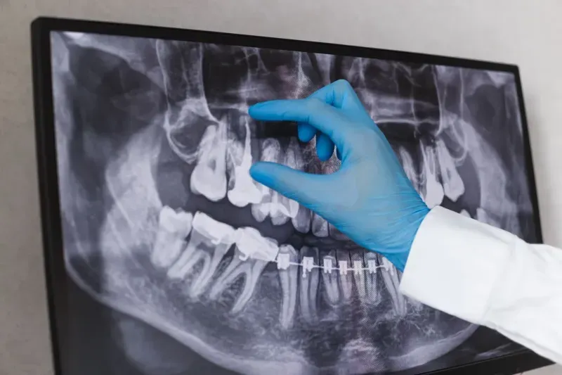 Root Canal Vs. Extraction: Which Is Right For You?